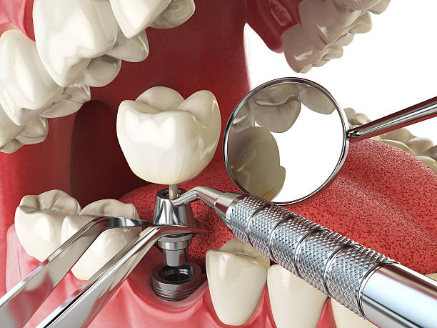 Best Emergency Tooth Extraction in Winters, CA